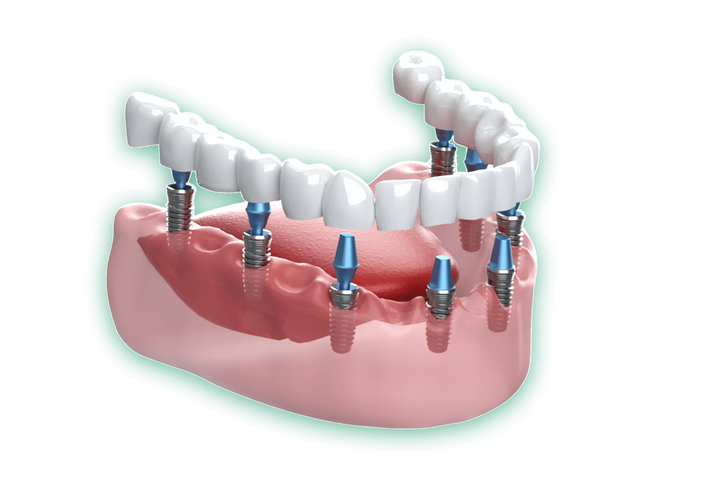 インプラント治療