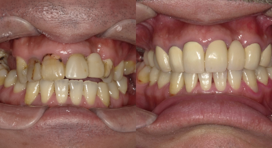 症例②インプラント