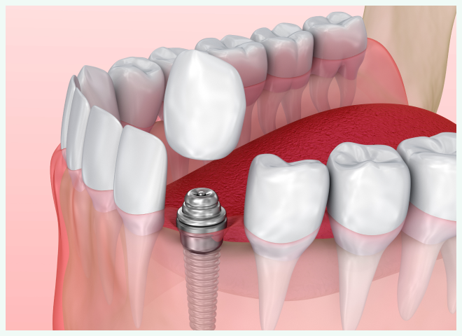 インプラントで失った機能を取り戻す