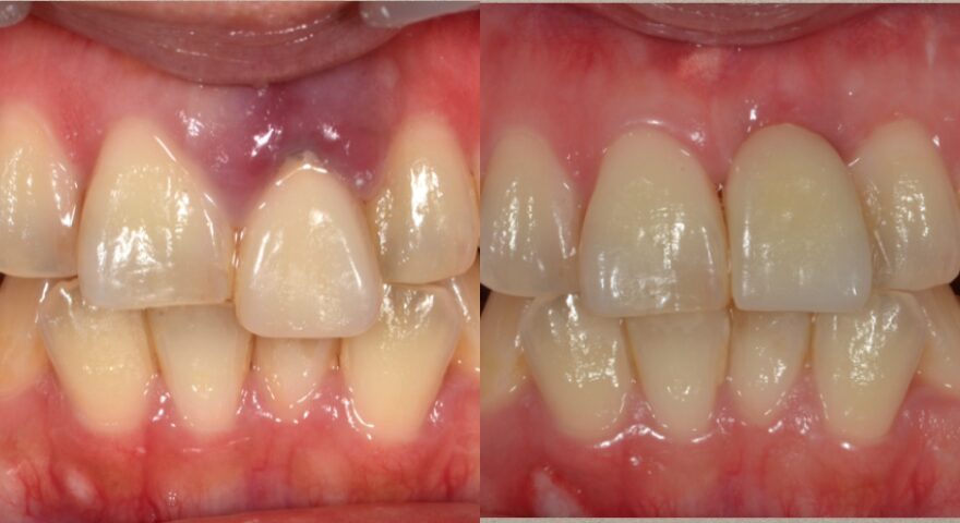 症例①ブルーラジカル