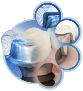 アストラティックインプラント