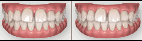 iTero（アイテロ）による歯並びのシミュレーション